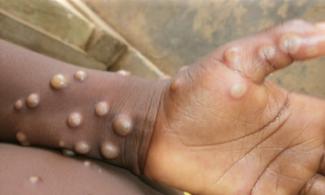 Chickenpox Outbreak Claims Many Lives In Nigerian Capital, Abuja, Authorities Confirm 