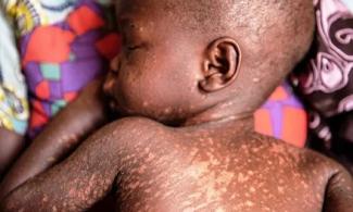 BREAKING: Adamawa Confirms 42 Dead In Measles Outbreak, Shuts All Primary, Secondary Schools